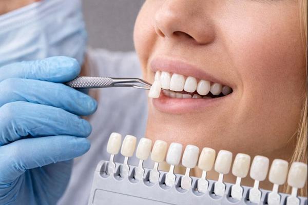 Лечение зубов винирами в стоматологии: эстетика улыбки без сложного терапевтического вмешательства