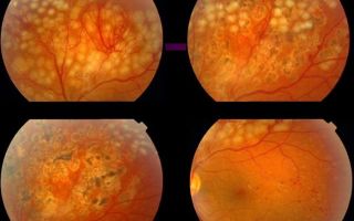 Что такое ретинопатия при сахарном диабете