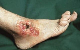 Диабетические язвы на ногах как выглядят, лечение