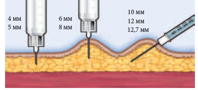 Какие бывают шприцы для инсулина и как ими правильно пользоваться
