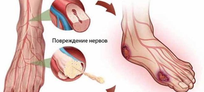 Гангрена (некроз) ног при диабете симптомы и лечение