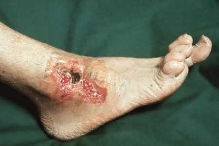 Ангиопатия ног при сахарном диабете и как ее лечить (с фото симптомов)