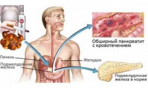Рак головки поджелудочной железы