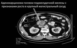 Анатомия и патологии хвоста поджелудочной железы