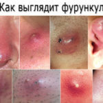 Сыпь на коже при сахарном диабете