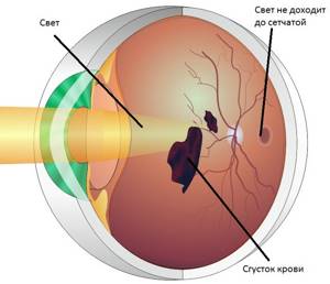 Диабетическая ретинопатия хотите сохранить зрение, не тяните с лечением