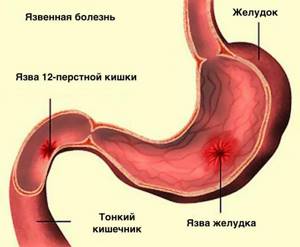 Особенности реактивных нарушений поджелудочной железы