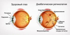 Диабетическая ретинопатия – причины, суть патологии, лечение