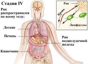 Рак поджелудочной железы 4 стадии