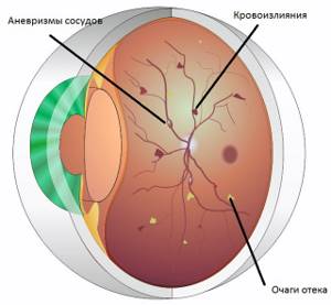 Диабетическая ретинопатия хотите сохранить зрение, не тяните с лечением