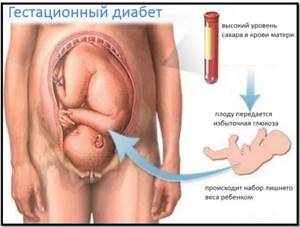 Диета беременных при гестационном сахарном диабете