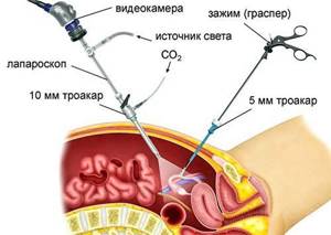 Методика проведения лапароскопии при панкреатите: показания и технология проведения