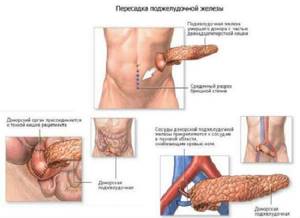Виды, процесс и показания к операции на поджелудочной железе при различных патологиях