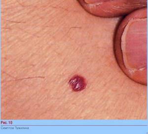 Красные точки Тужилина при панкреатите
