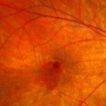Как сахарный диабет влияет на зрение и заболевания глаз