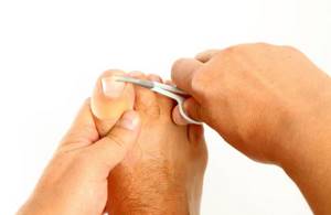 Изменения ногтей при сахарном диабете