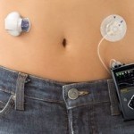 Микроинфузионная инсулиновая помпа – новое слово в лечении диабета