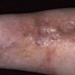 Красные пятна на ногах при сахарном диабете: подробнее об изменениях кожи