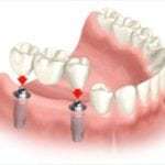 Имплантация зубов при сахарном диабете: советы стоматолога