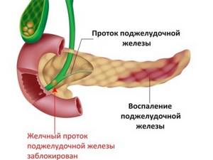 Операция на поджелудочной при панкреатите