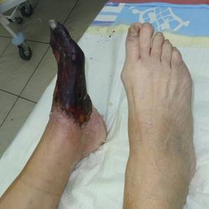Гангрена (некроз) ног при диабете симптомы и лечение