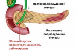Приступ панкреатита (поджелудочной железы)