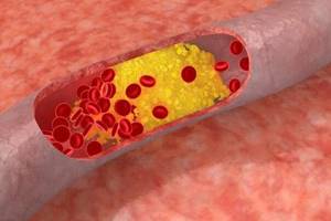 Атеросклероз как спутник сахарного диабета