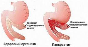 Особенности диффузных изменений поджелудочной железы