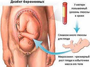 Признаки сахарного диабета у беременных женщин
