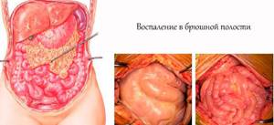 Виды и осложнения травмы поджелудочной железы