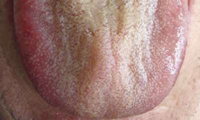 Изменения кожных покровов при панкреатите