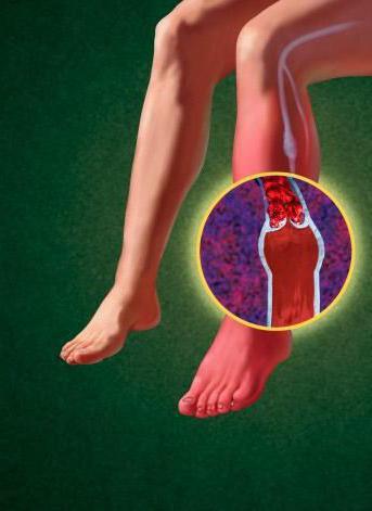 Ангиопатия ног при сахарном диабете и как ее лечить (с фото симптомов)