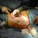 Трансплантация поджелудочной железы при диабете
