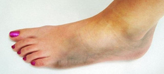 Гангрена (некроз) ног при диабете симптомы и лечение
