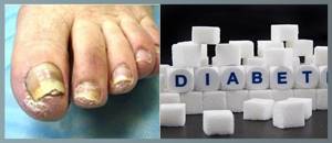 Изменения ногтей при сахарном диабете