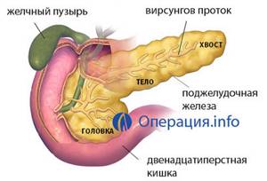 Виды, процесс и показания к операции на поджелудочной железе при различных патологиях