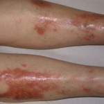 Красные пятна на ногах при сахарном диабете: подробнее об изменениях кожи