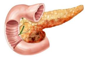 Отличительные признаки хронического панкреатита от острого воспаления поджелудочной железы