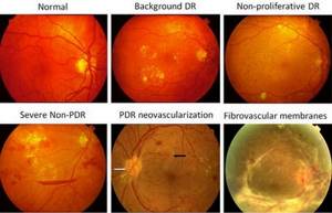Капли для глаз при сахарном диабете (ретинопатии)