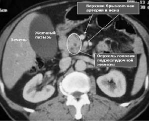 Что такое магнитно-резонансная томография поджелудочной железы, и что она показывает?