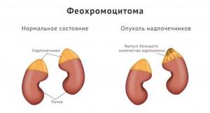 Что такое полиурия и как она связана с диабетом?