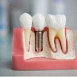 Можно ли ставить зубные импланты и протезы при диабете