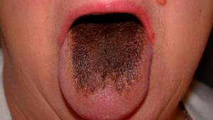 Цвет языка при диабете: о чем свидетельствует белый налет