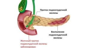 Причины и лечение острого отечного панкреатита: как и чем снять отёк поджелудочной железы?
