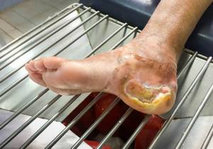 Особенности лечения трофических язв на ногах при сахарном диабете