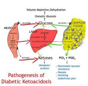 Диабетический кетоацидоз: что это и как его лечить
