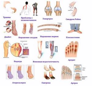 Онемение пальцев ног и стопы при сахарном диабете