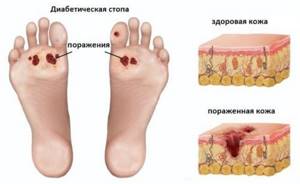 Особенности лечения трофических язв на ногах при сахарном диабете