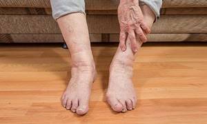 Опухоли и отеки ног при сахарном диабете лечение